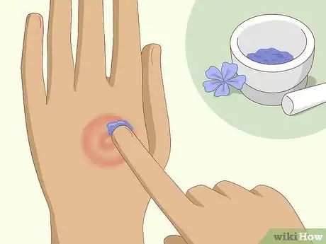 Imagen titulada Get Rid of Ringworm Naturally Step 3