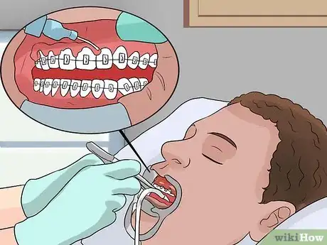 Imagen titulada Whiten Your Teeth when You Have Braces Step 8