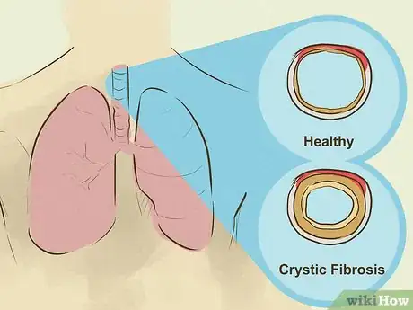 Imagen titulada Diagnose Lung Hyperinflation Step 10