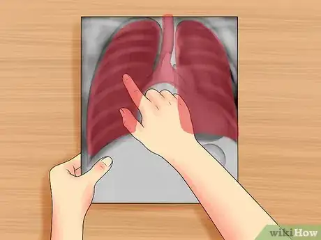 Imagen titulada Read a Chest X Ray Step 14