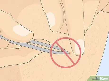 Imagen titulada Remove an Ingrown Hair Under the Skin Step 9