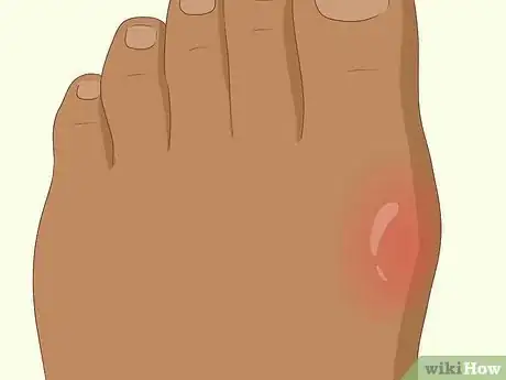 Imagen titulada Recognize Gout Symptoms Step 5