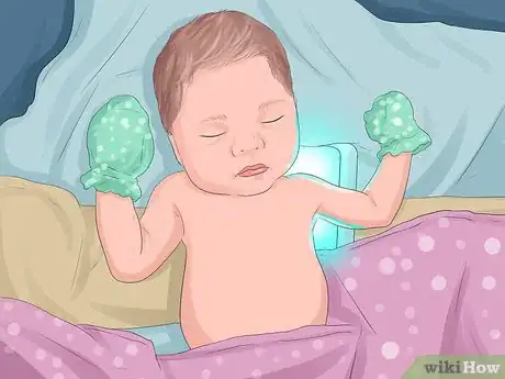 Imagen titulada Prevent Jaundice in Newborns Step 6