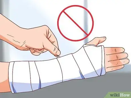 Imagen titulada Apply a Cast to a Broken Arm Step 14