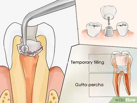 Imagen titulada Treat a Tooth Abscess Step 6