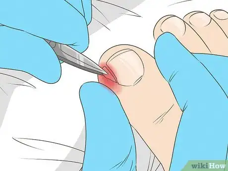 Imagen titulada Will an Ingrown Toenail Heal Itself Step 11