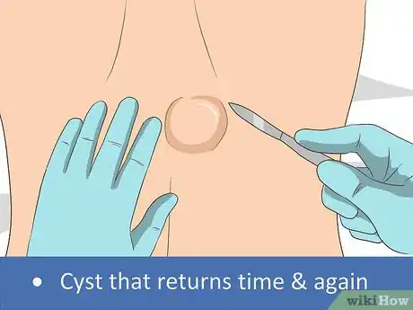 Imagen titulada Remove a Cyst on Your Back Step 8