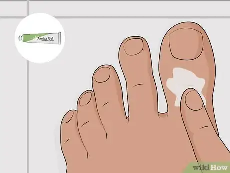 Imagen titulada Heal a Bruised Toenail Quickly Step 11