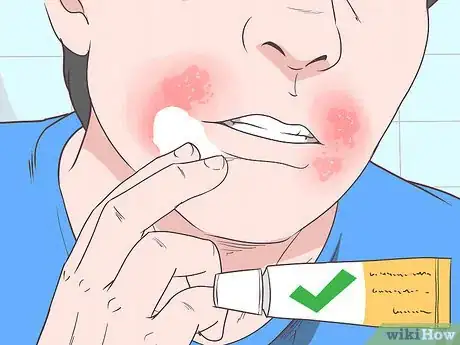 Imagen titulada Treat Perioral Dermatitis Step 2