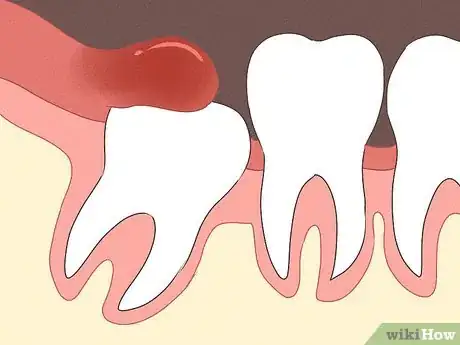 Imagen titulada Tell Between an Erupting and Impacted Wisdom Tooth Step 8