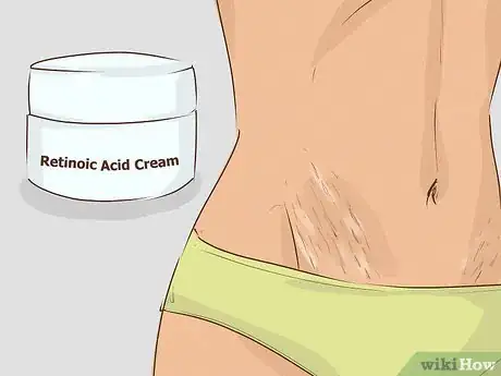 Imagen titulada Get Rid of Stretch Marks Step 1