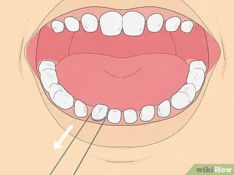 Imagen titulada Pull a Loose Tooth at Home Step 9