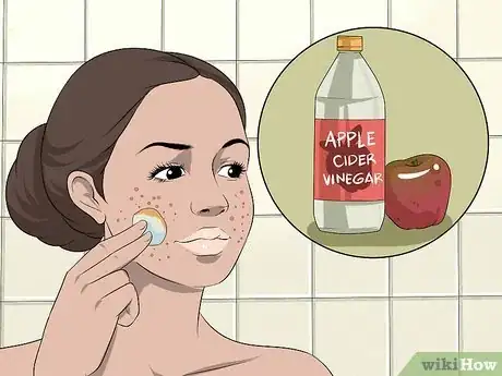 Imagen titulada Dry Out a Pimple Step 16