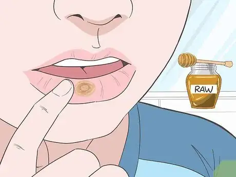 Imagen titulada Treat Mouth Ulcers Naturally Step 1