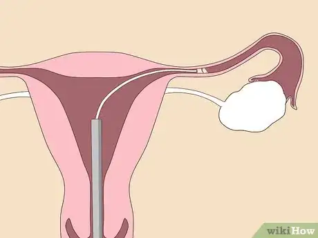 Imagen titulada Unblock Fallopian Tubes Naturally Step 2