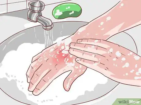 Imagen titulada Handle an Eczema Flare Up Step 15