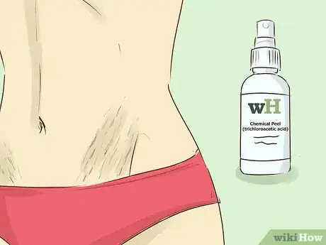 Imagen titulada Get Rid of Stretch Marks Step 3