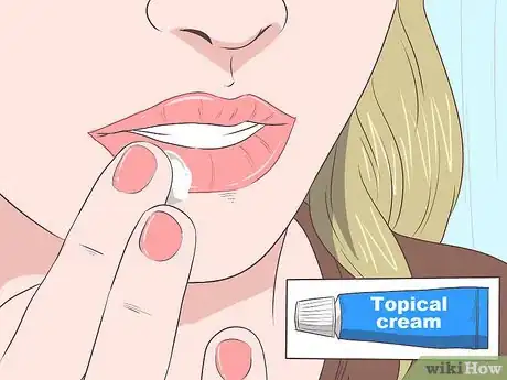 Imagen titulada Treat a Cold Sore or Fever Blisters Step 24