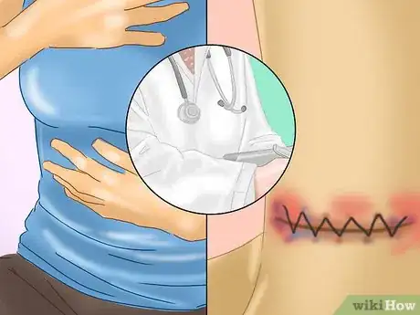 Imagen titulada Take Care of an Incision After Thyroid Surgery Step 11