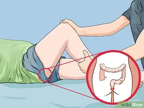 Imagen titulada Treat Hemorrhoids After Pregnancy Step 12