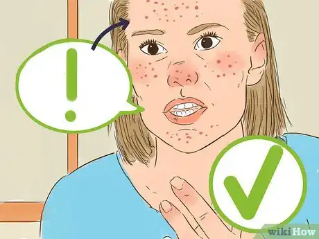 Imagen titulada Be Confident If You Have Acne Step 8