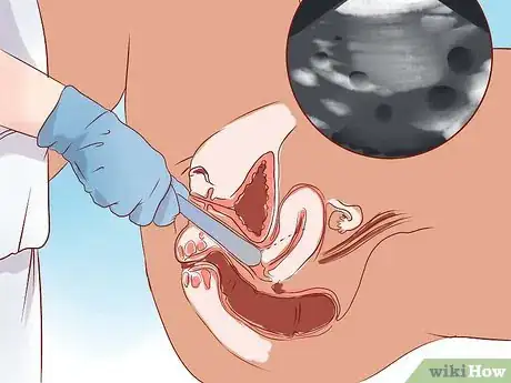 Imagen titulada Detect an Ectopic Pregnancy Step 7