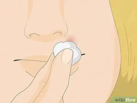 Imagen titulada Pop a Pimple Step 24