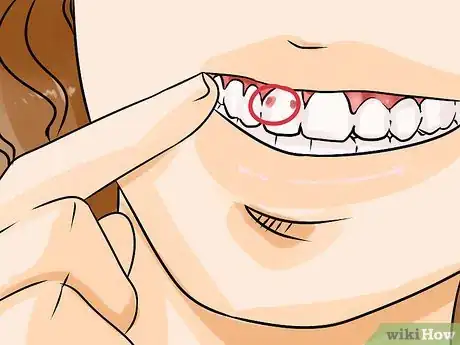 Imagen titulada Know if You Have a Cavity Step 1