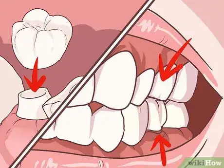 Imagen titulada Fix a Lost Dental Crown Step 8