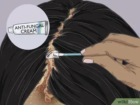 Imagen titulada Grow Hair Back After a Scalp Fungal Infection Step 3