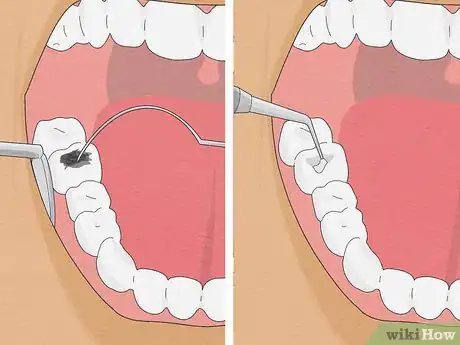 Imagen titulada Fix Rotting Teeth Step 3