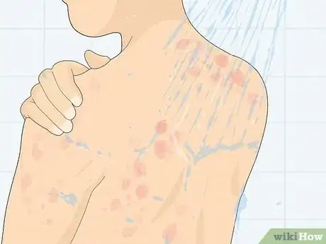 Imagen titulada Recognize Hives (Rash) Step 10