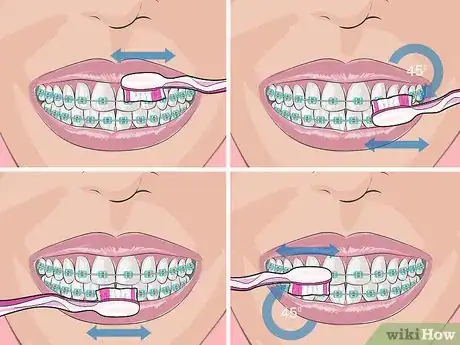 Imagen titulada Deal with Braces Step 1