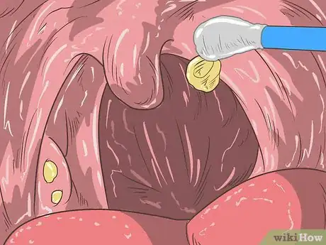 Imagen titulada Remove Tonsil Stones (Tonsilloliths) Step 11
