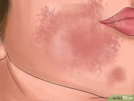 Imagen titulada Treat a Yeast Infection on Your Skin Step 1