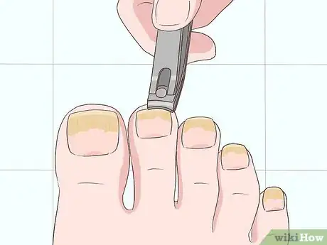 Imagen titulada Treat Toe Nail Fungus Step 1