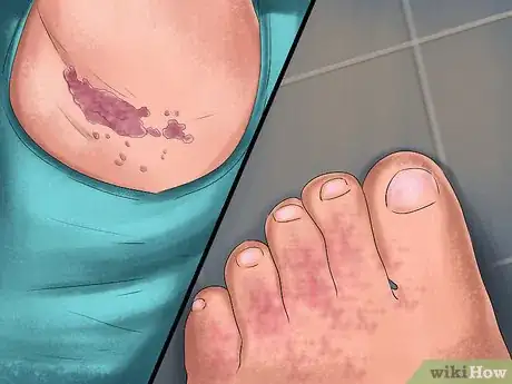 Imagen titulada Treat a Yeast Infection on Your Skin Step 4