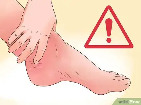 Imagen titulada Cure a Swollen Ankle Step 17