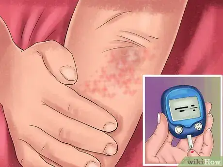 Imagen titulada Treat a Yeast Infection on Your Skin Step 5