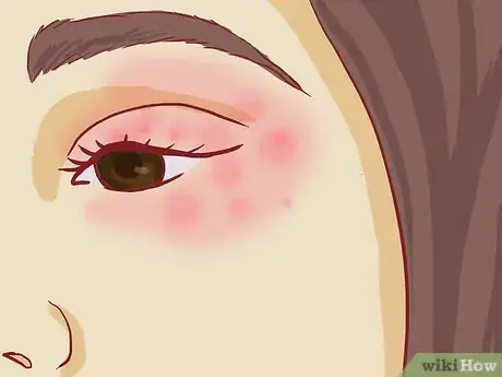 Imagen titulada Treat Eczema Around the Eyes Step 2