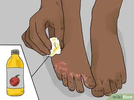 Imagen titulada Use Apple Cider Vinegar for Athlete's Foot Step 6