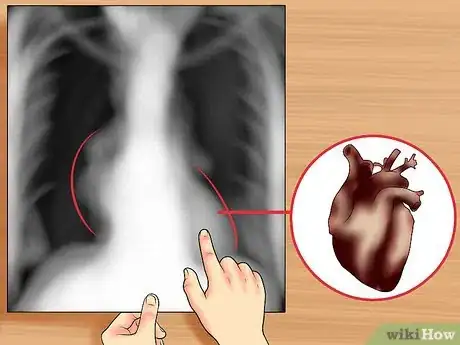 Imagen titulada Read a Chest X Ray Step 18