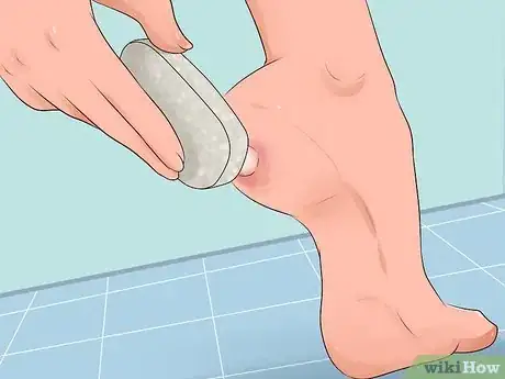 Imagen titulada Get Rid of a Wart at the Bottom of Your Foot Step 1