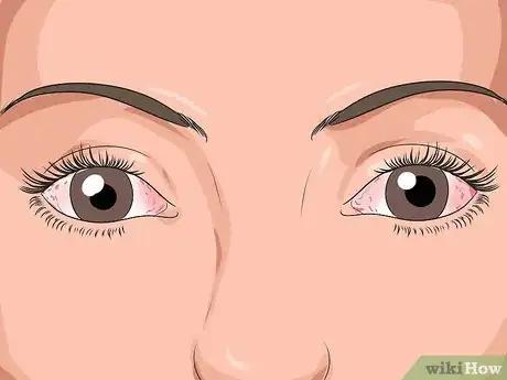 Imagen titulada Get Rid of Pink Eye Fast Step 1