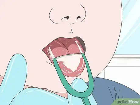 Imagen titulada Know if You Have Oral Thrush Step 12