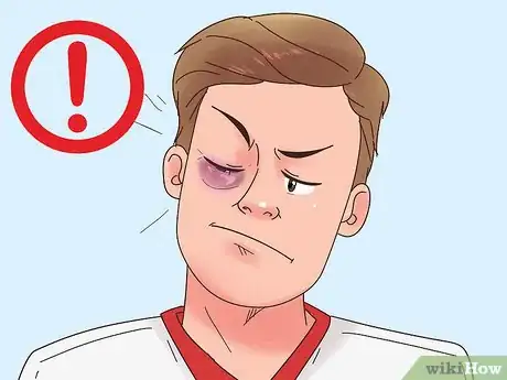 Imagen titulada Get Rid of a Black Eye Step 3