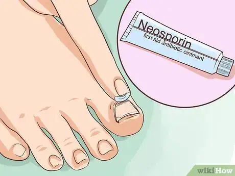 Imagen titulada Treat a Torn Toenail Step 4