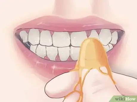 Imagen titulada Treat Gum Disease With Home Made Remedies Step 4
