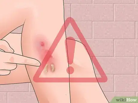 Imagen titulada Ease the Symptoms of Spongiotic Dermatitis Step 2