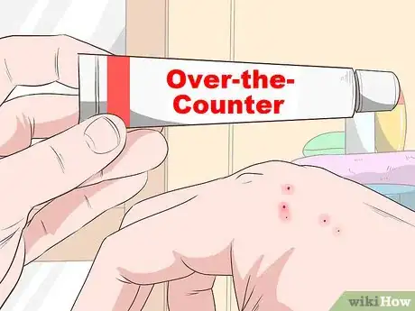 Imagen titulada Stop Mosquito Bites from Itching Step 7